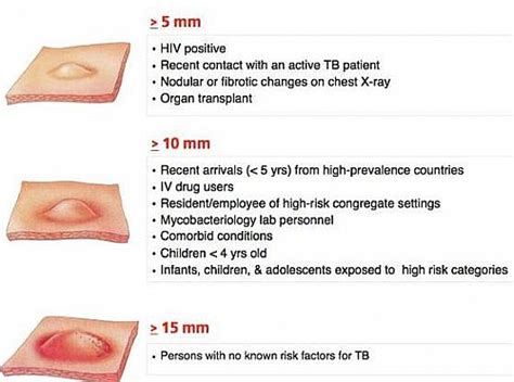 mantoux test positive result images|The TB (Tuberculosis) Skin Test (Mantoux) .